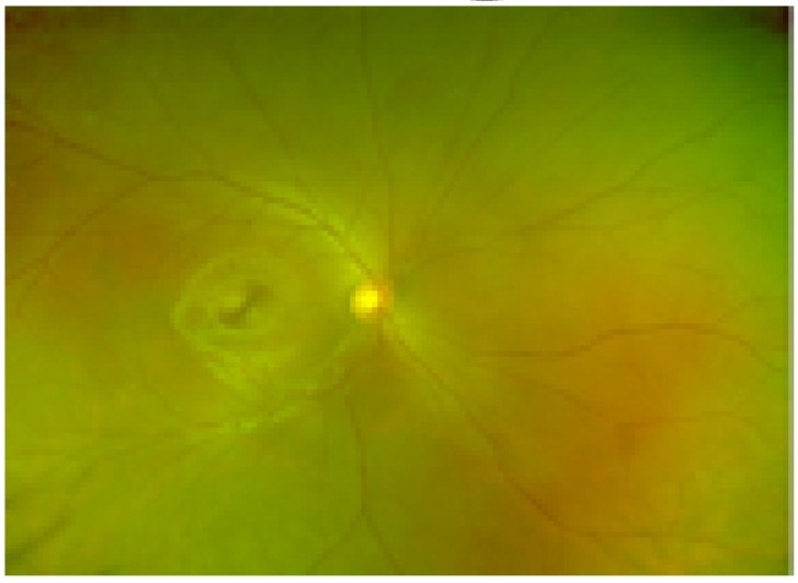 Sports-related Eye Injuries